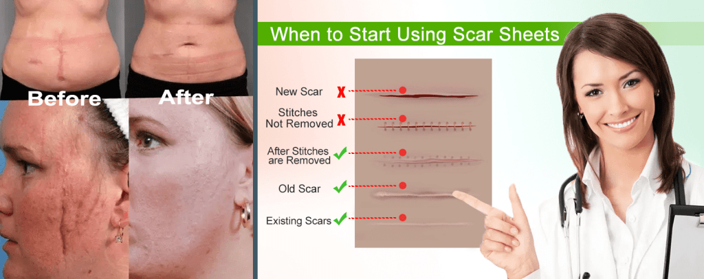 Silicone scar tape and gel for effective scar care